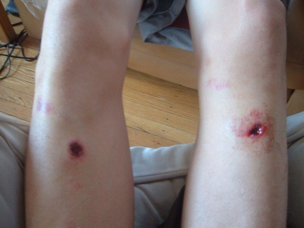 Puncture to the bone