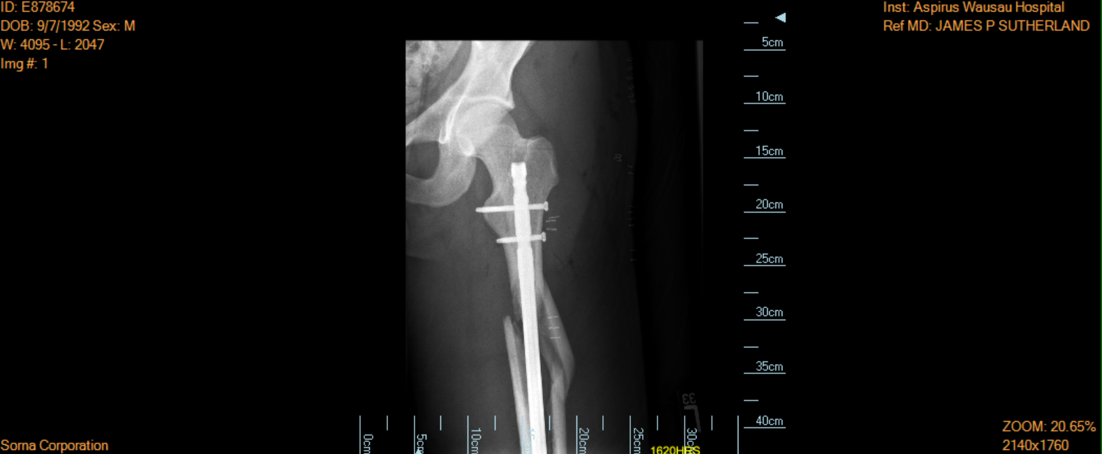 Rod in Femur