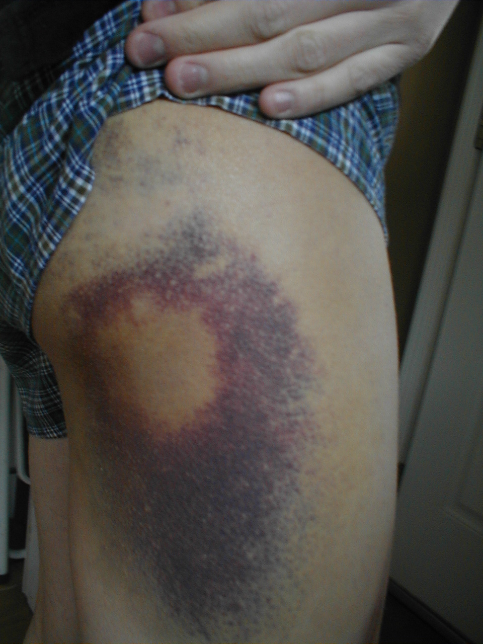 Secksy Leg Bruise 07-08
