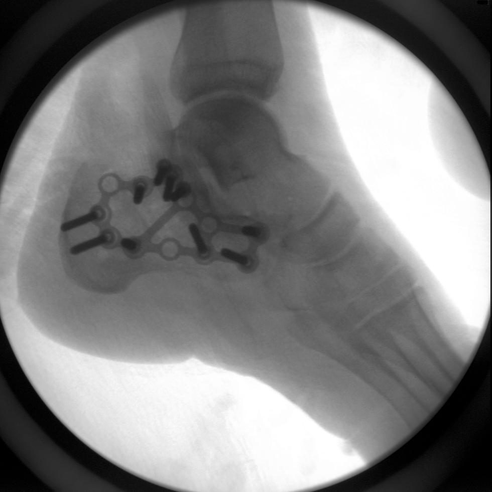 Shattered Heel Yo FROM URBaN its dangerous