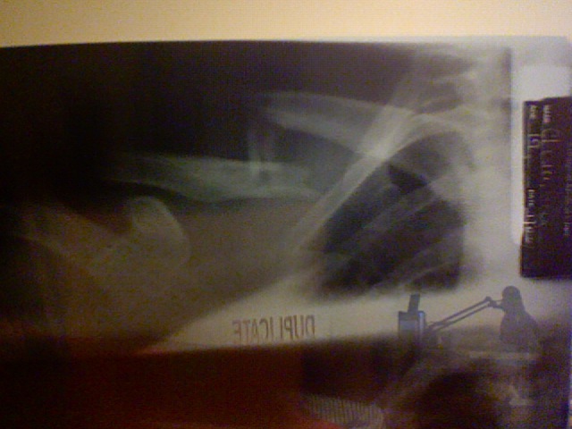 Shitty pic Xray