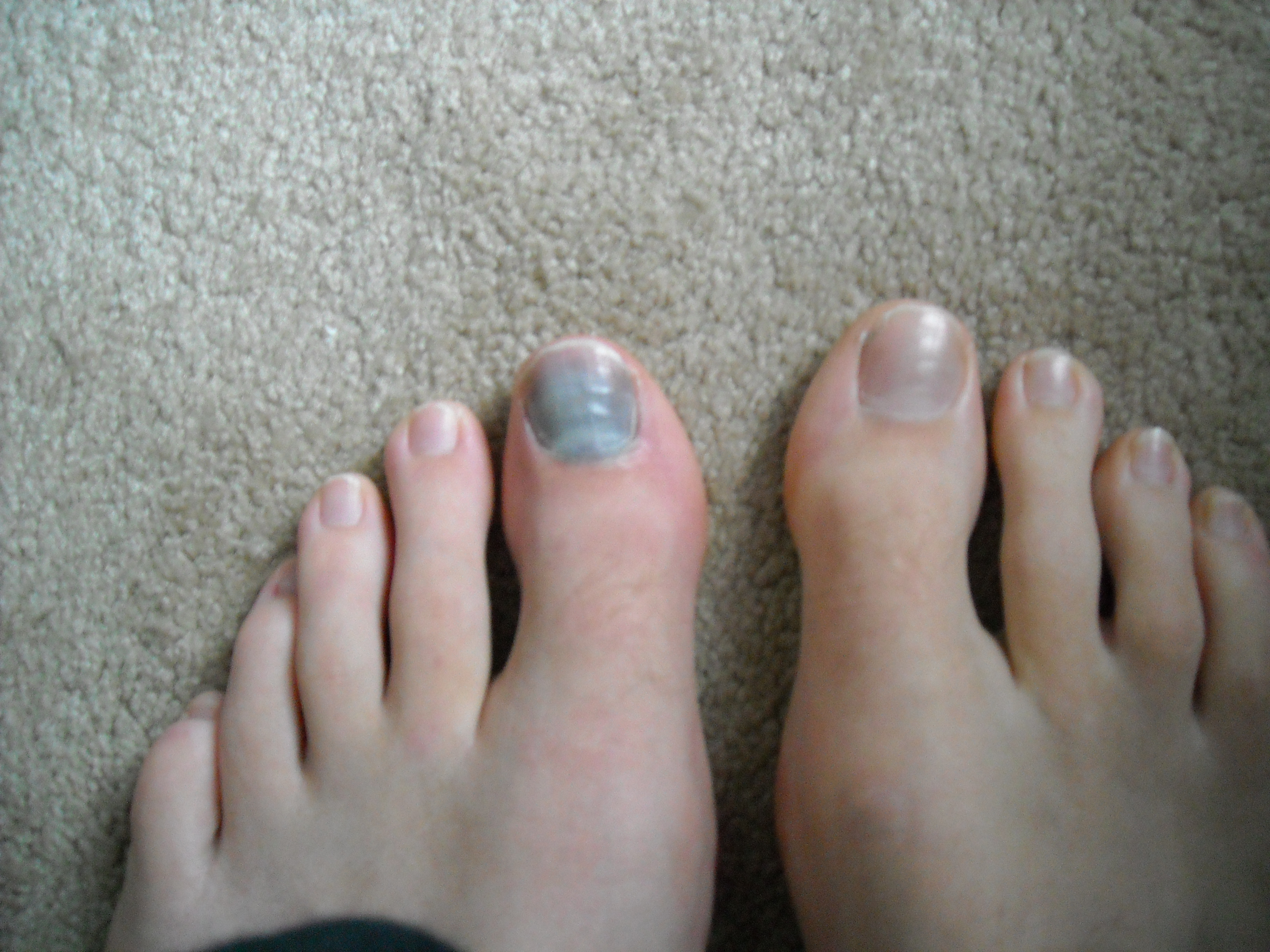 Skiers worst nightmare