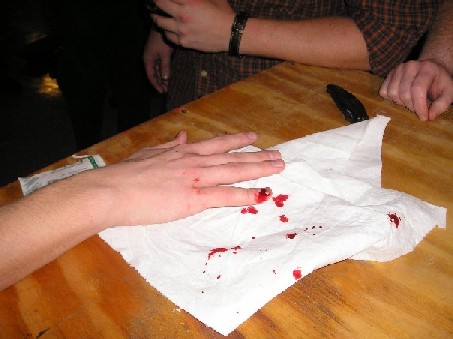 smashed pinky under my ski