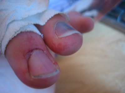 Smashing my fingers is my hobbie