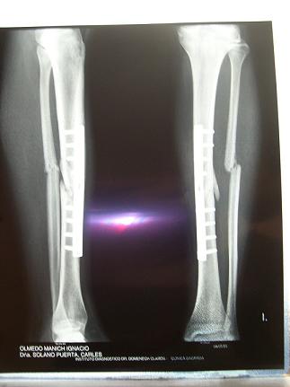 some broken bones...