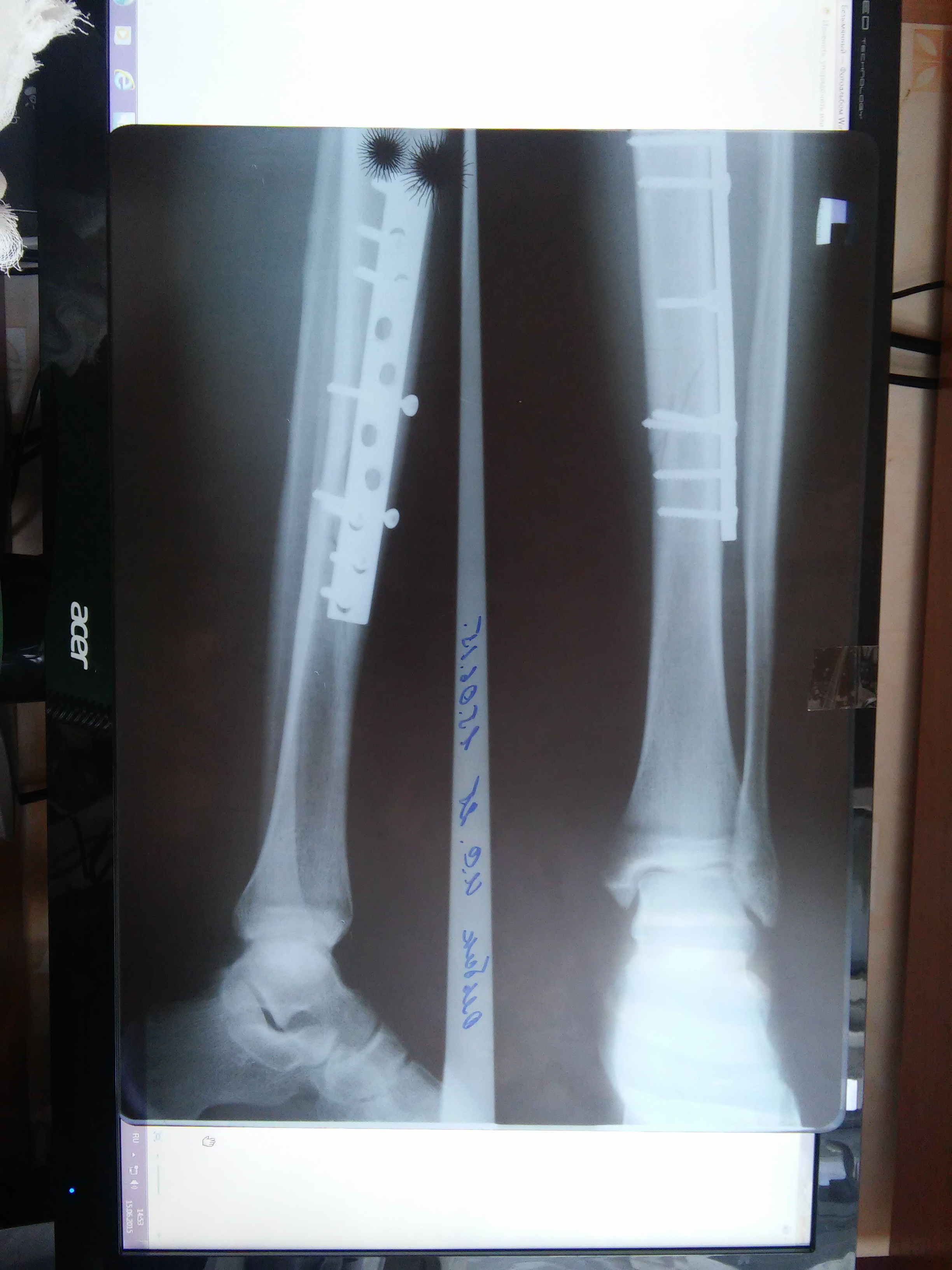 spiral comminuted fracture