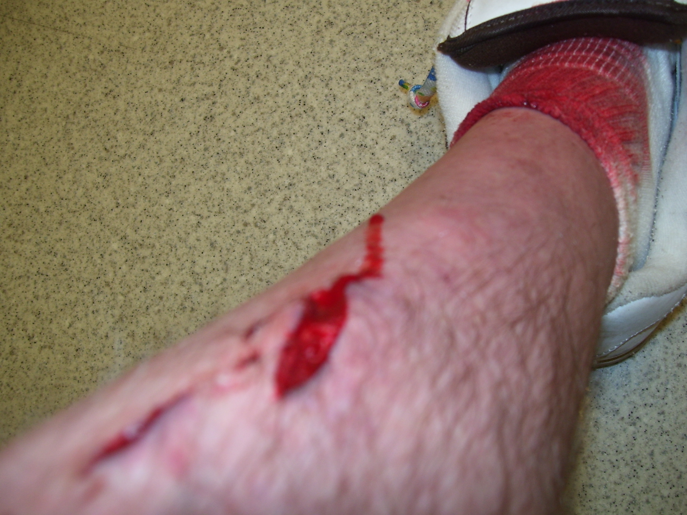 Starting to get gory