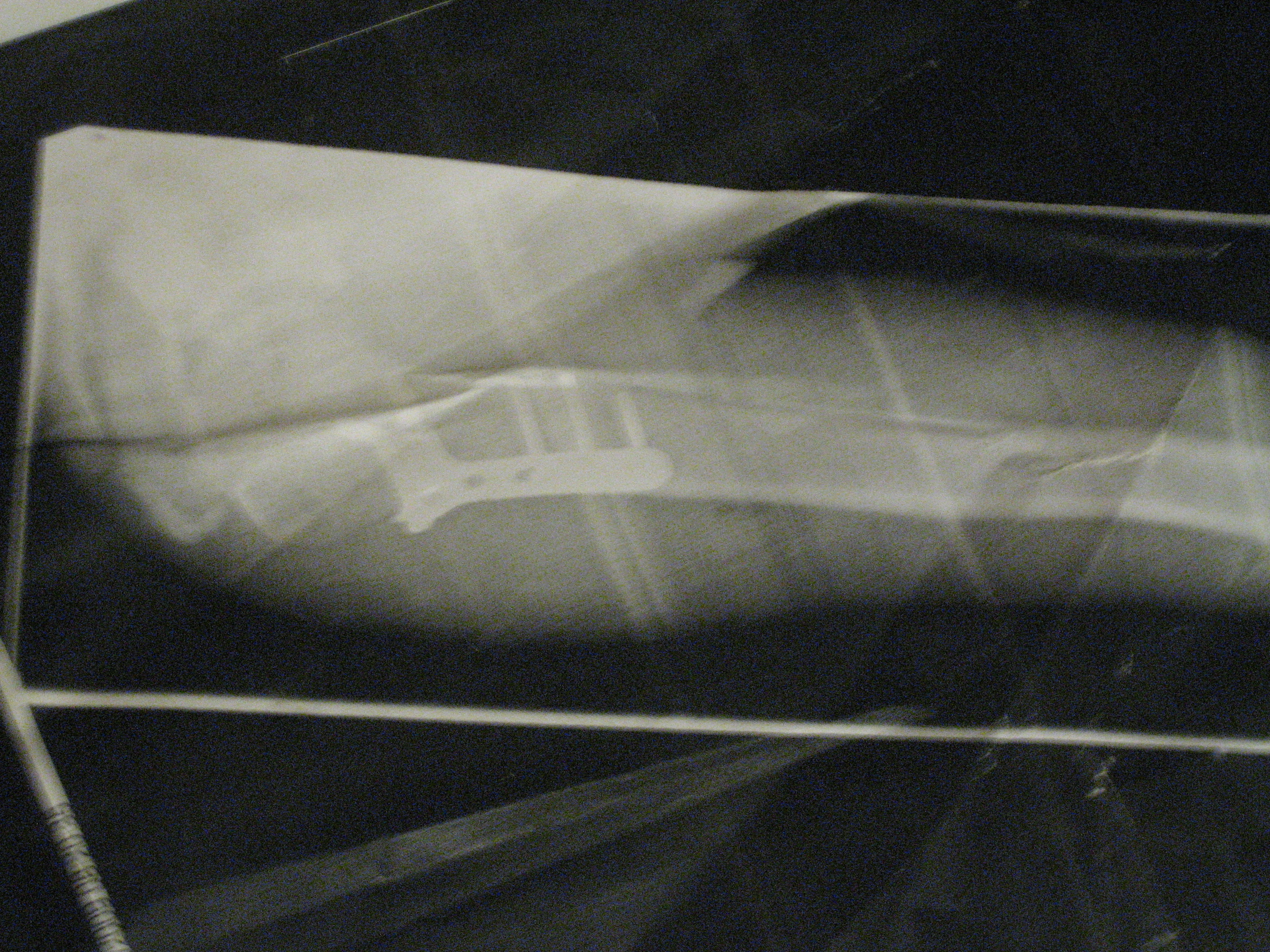 Surgery on humerus bone