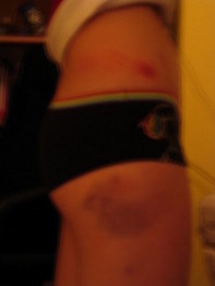 The bruise i forgot about