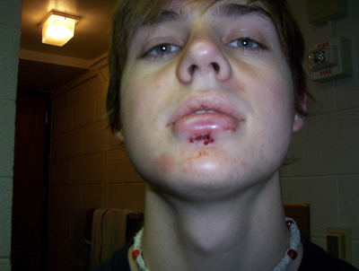 The new hole in my lip