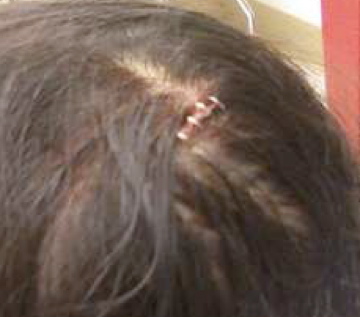 This is why you should wear a helmet.