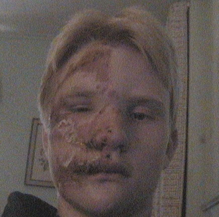 This really hurt. (nasty looking person warning)