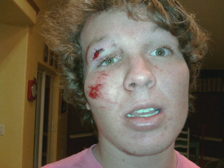 Tree skiing gone wrong