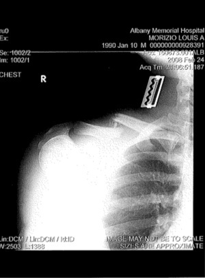 What was my collarbone