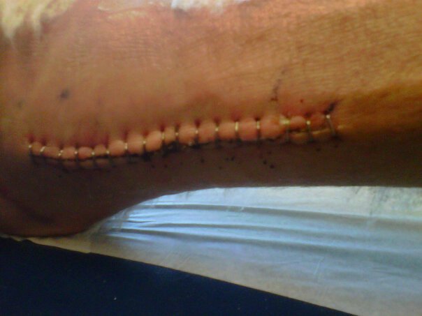 Where they shanked me