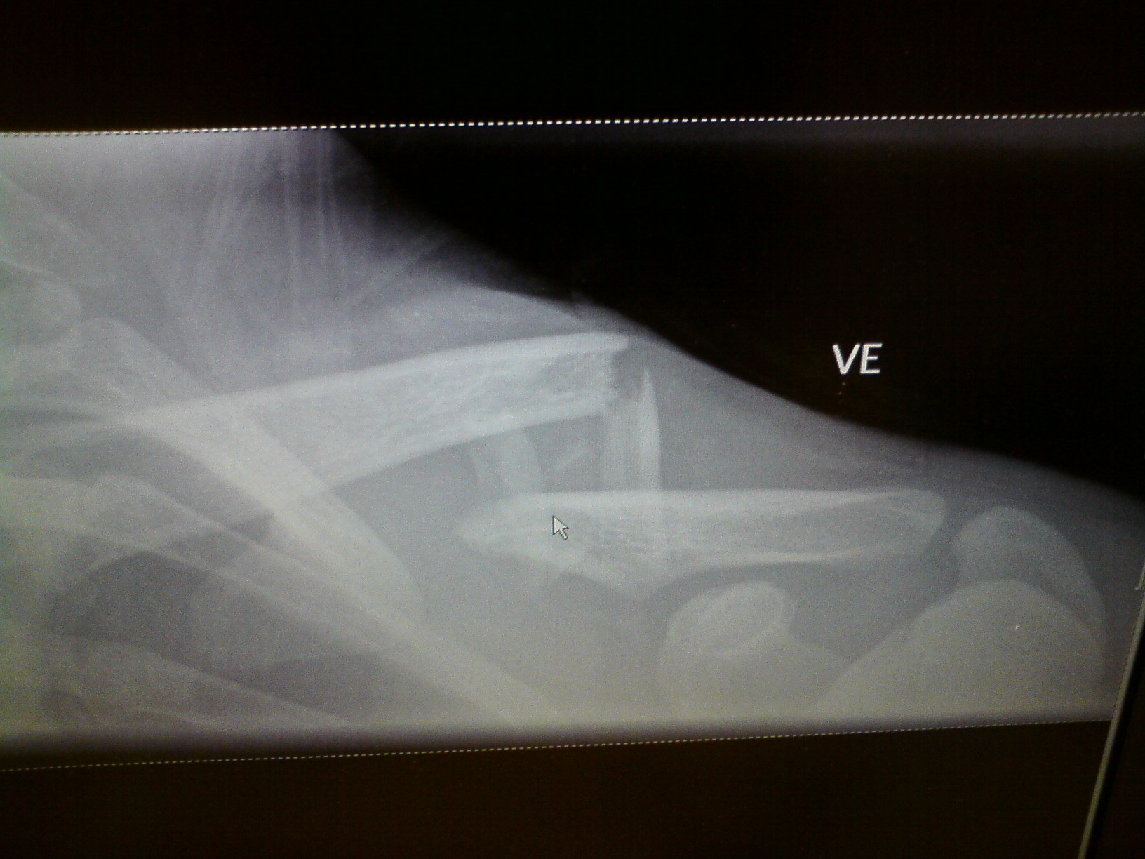 Yeah, that was the end of my season....